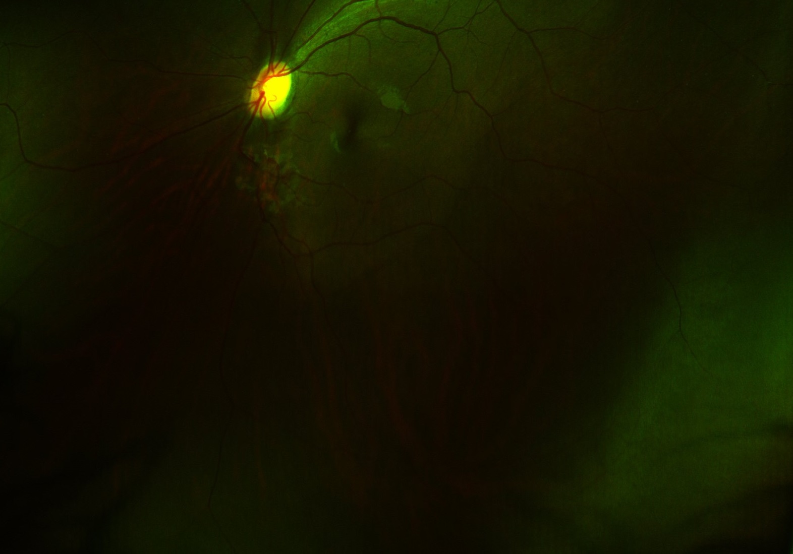 Digital retinal imaging scan, depicting blood vessels and nerves against a sea of green and black.