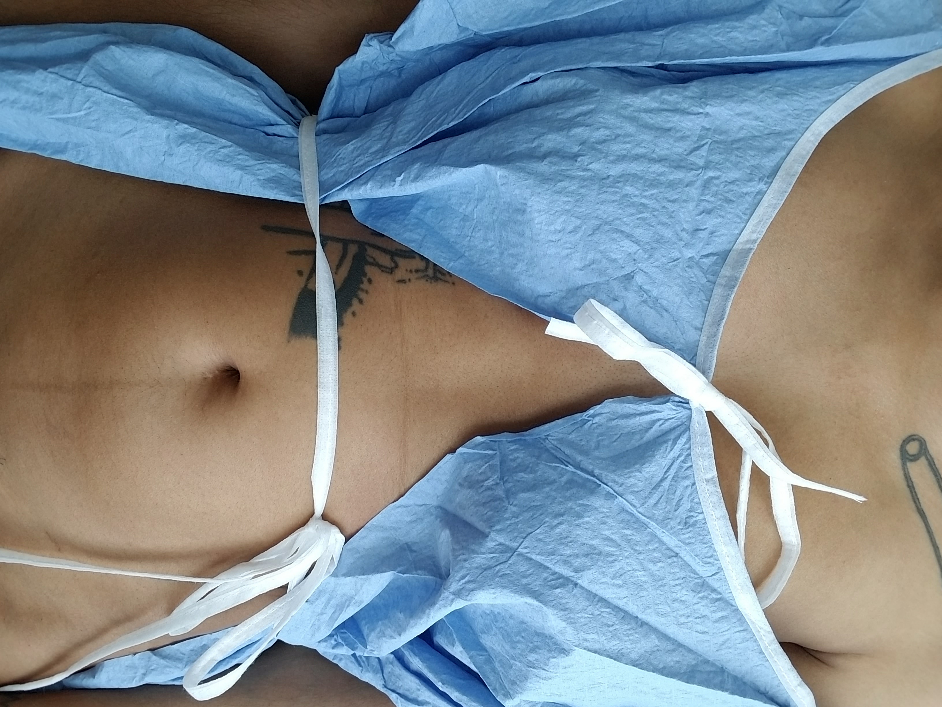 I pose in a blue paper hospital gown, open to the front, displaying scars at my hip and navel.