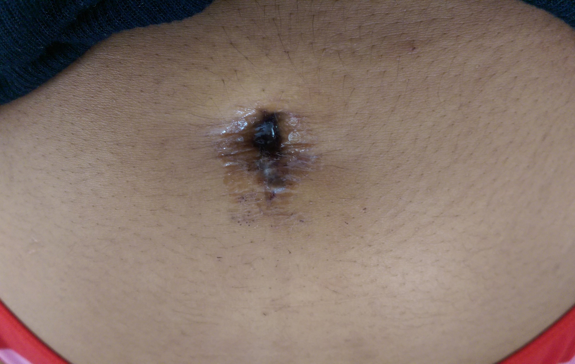 A navel sealed with surgical glue.
