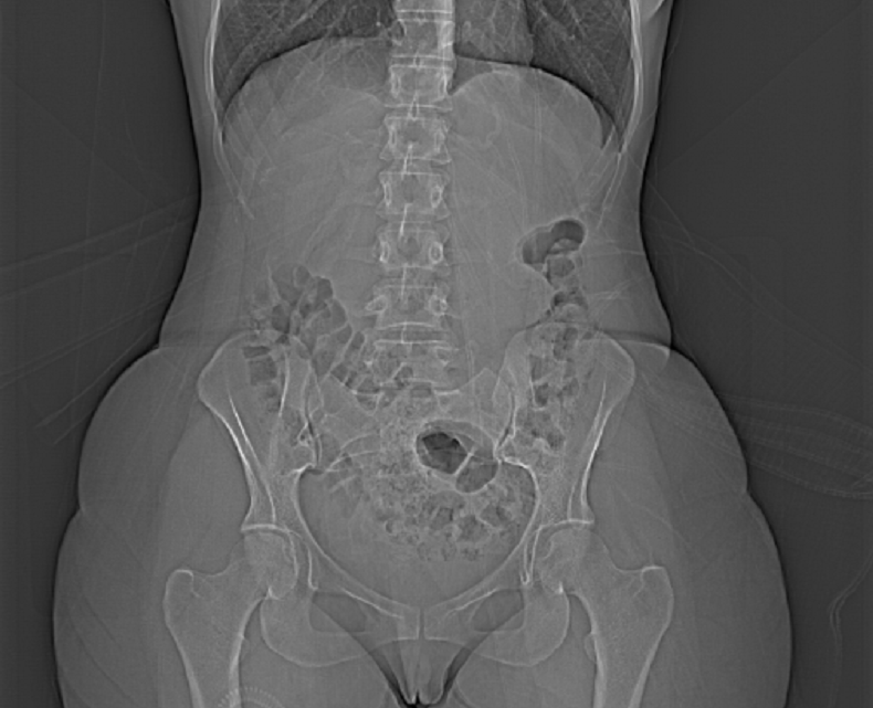 Coronal CT of the abdomen.