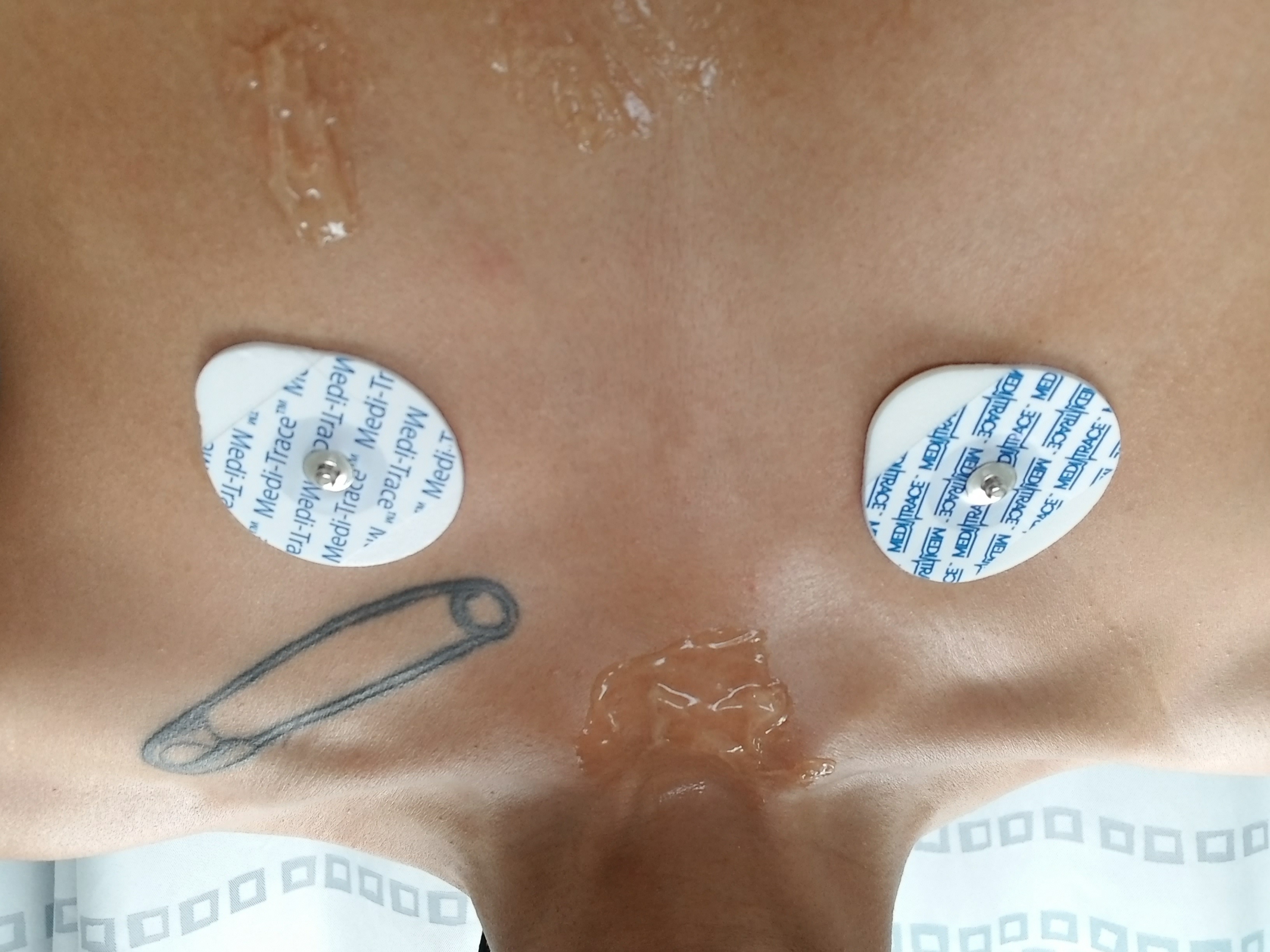 My upper chest smeared in conductive gel and stickered with two electrodes.