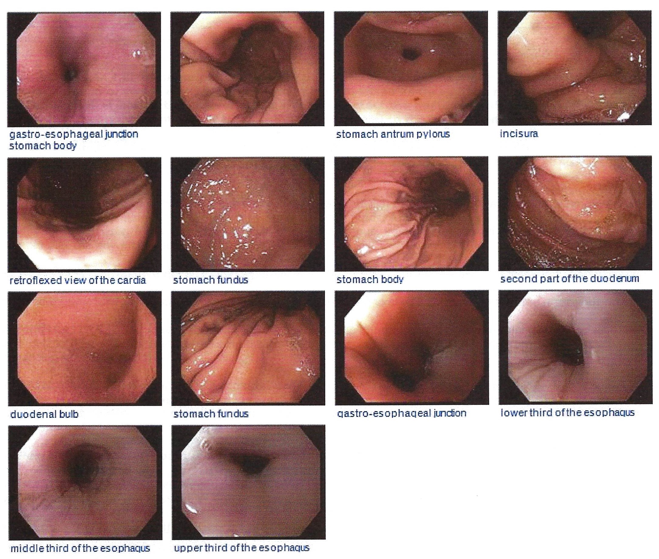 A grid of endoscopy photographs of the esophagus, stomach, and duodenum.