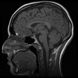 MRI sagittal view of the brain.