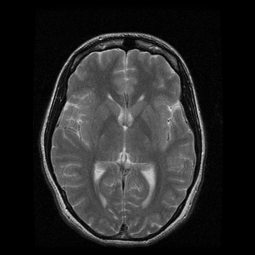 MRI top view of the brain.