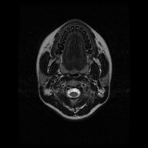 MRI axial view of the brain.