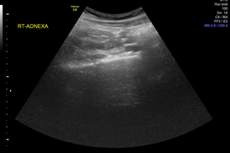 Ultrasound of right adnexa.