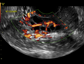 2017 ultrasound of the right ovary with color Doppler.