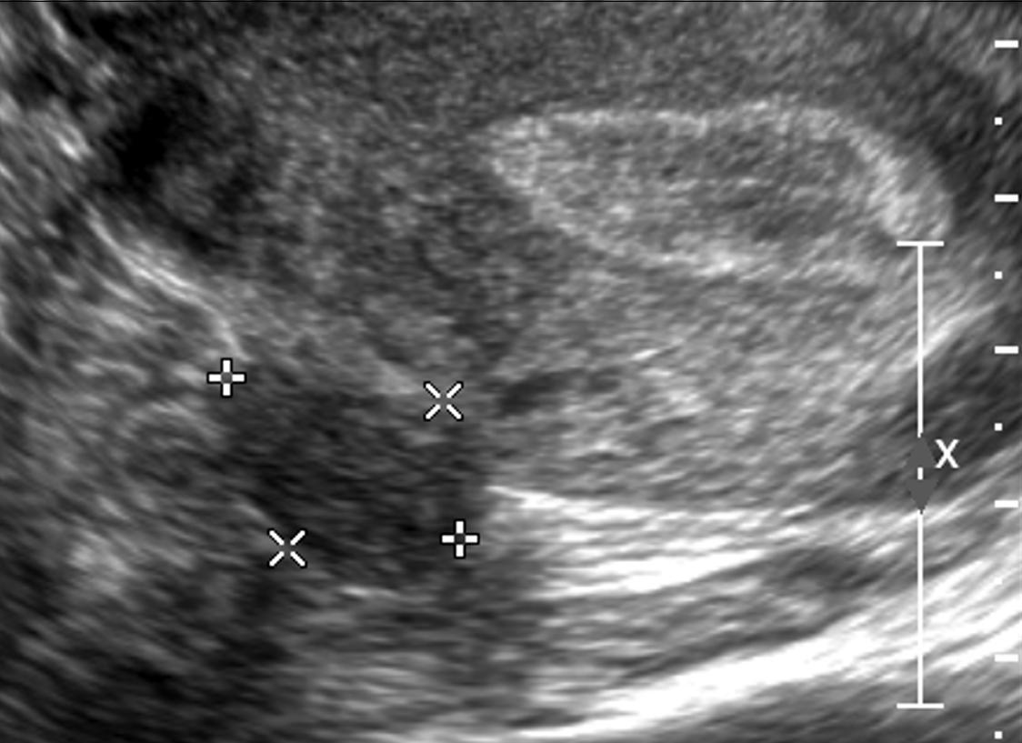 Pelvic ultrasound showing a pedunculated fibroid in the uterus.