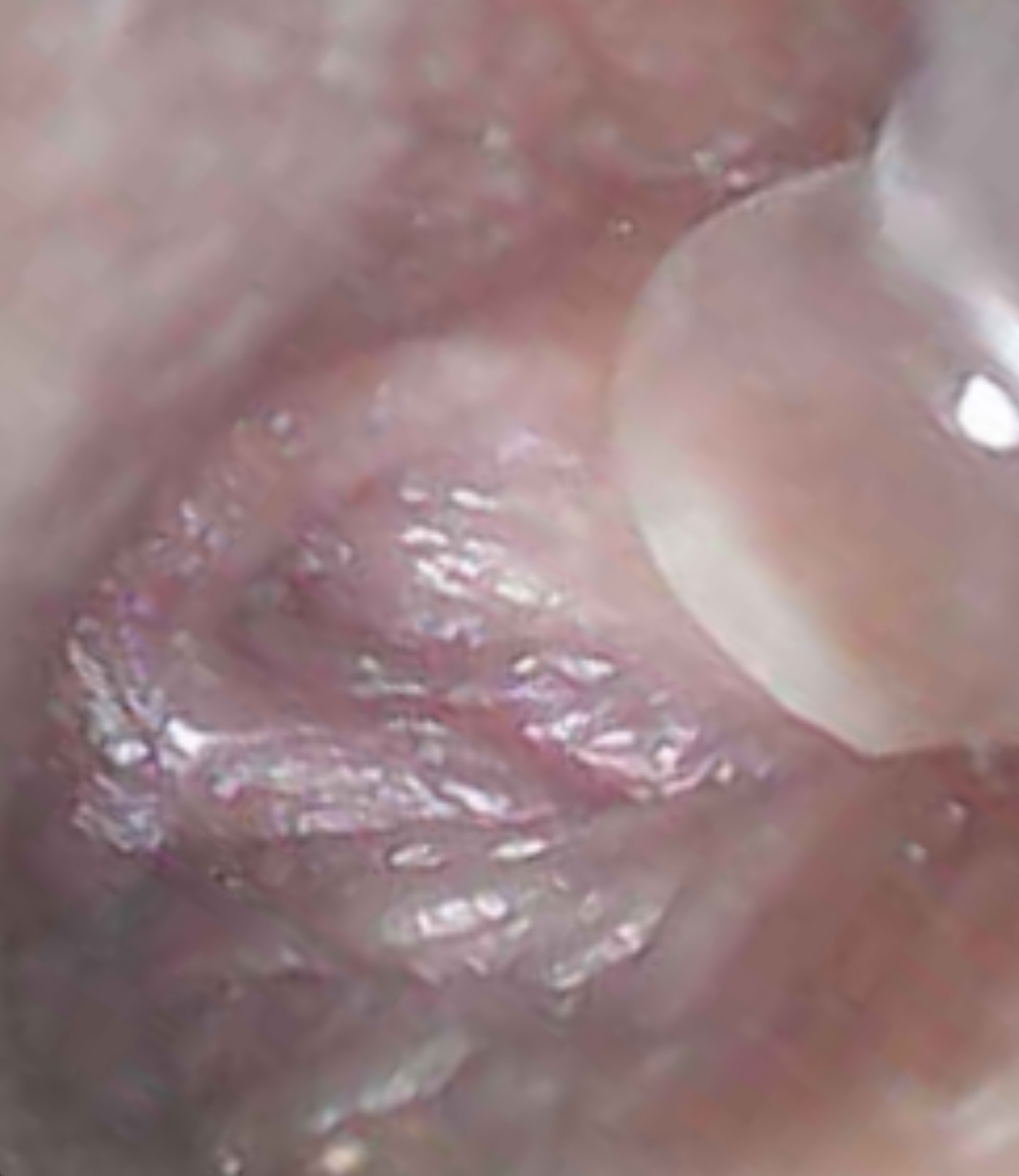 A tunnel of pale, puckered flesh, dilated by a clear plastic depressor, ends in a dark divot.