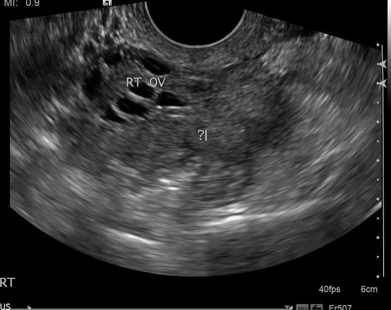 A single frame of a right view of a transvaginal ultrasound highlights a slightly dark area with black spots labeled 'Rt Ov' and a large dark gray shadow with a streaky asymmetrical border labeled '?|'